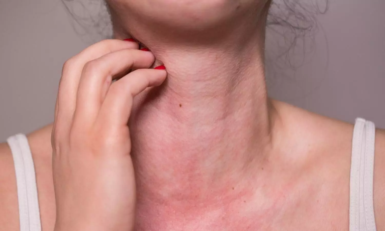 Image representing Skin Allergy