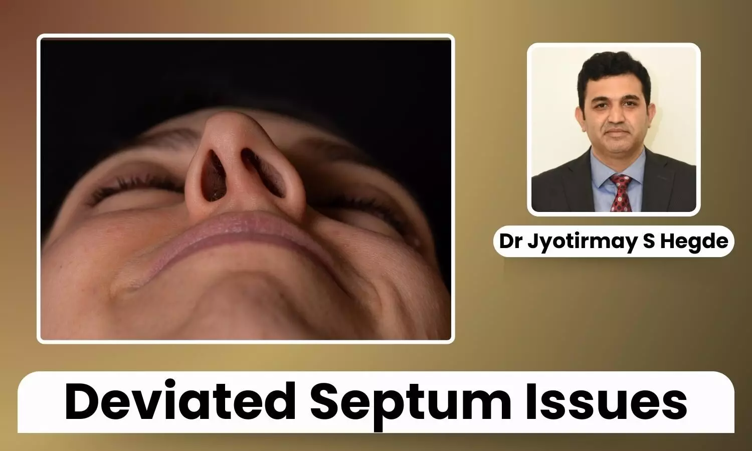 Featured image representing Deviated Septum