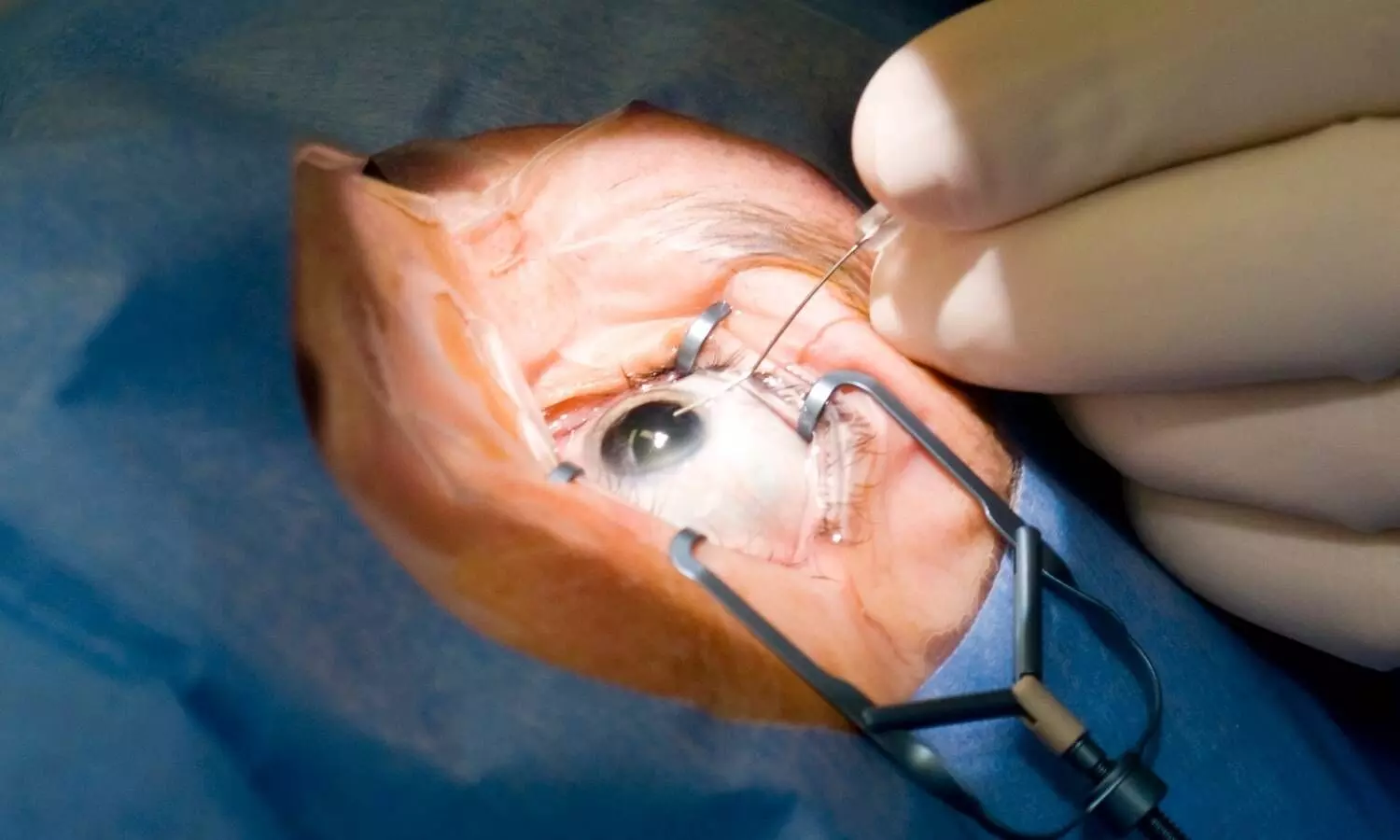 Featured image representing eye surgery