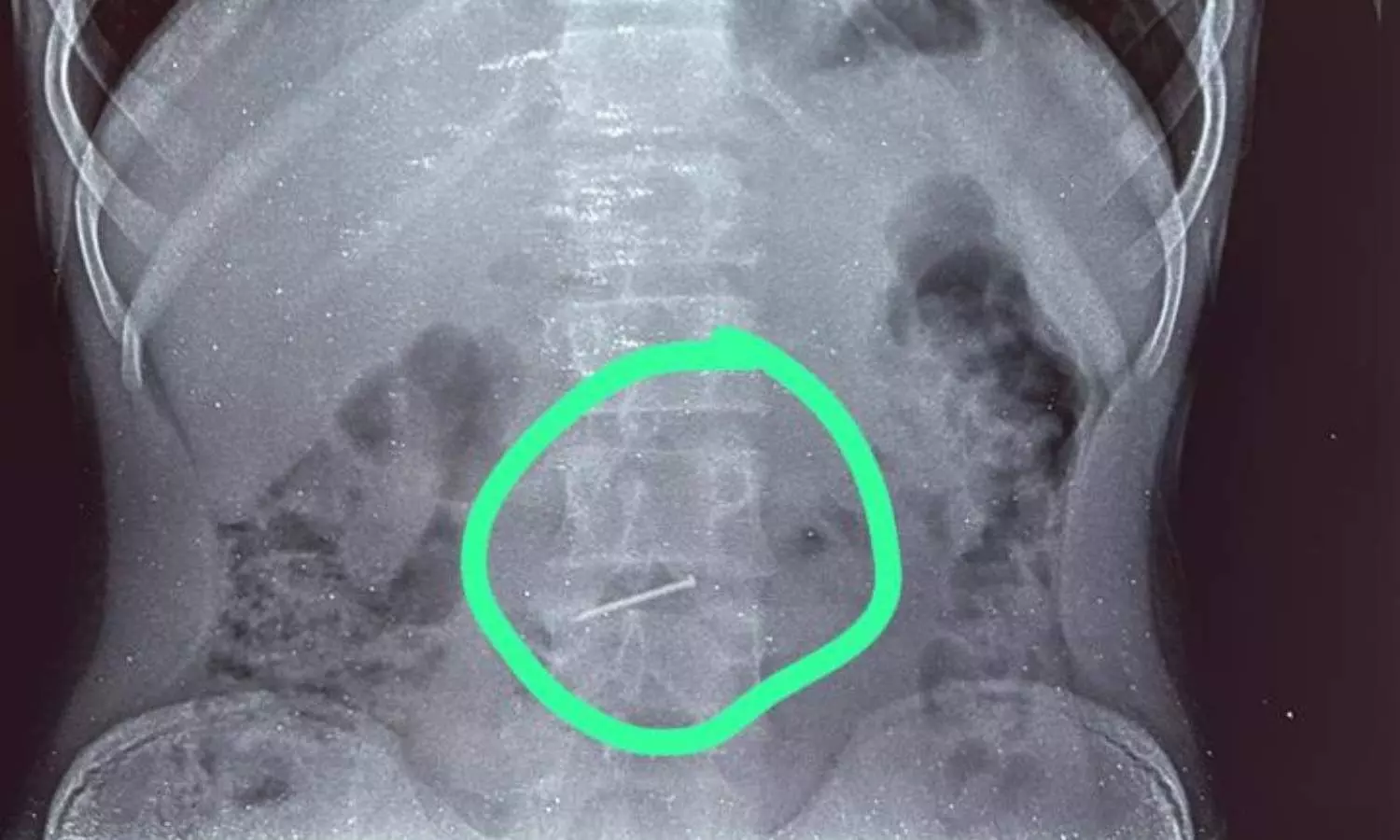 X-ray image of the nail in stomach of the carpenter