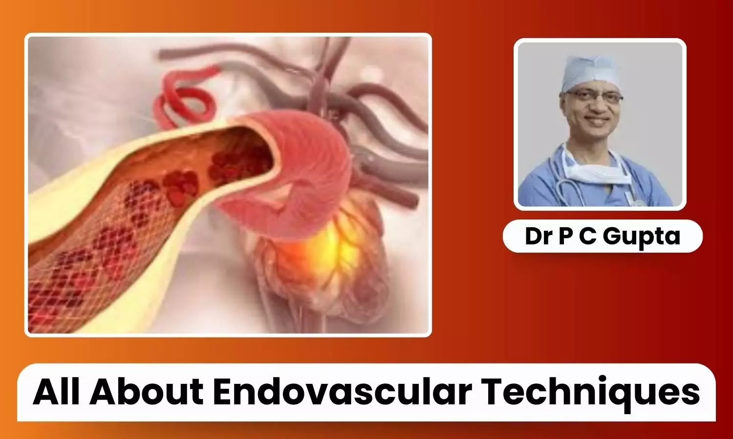 Featured image representing endovascular care