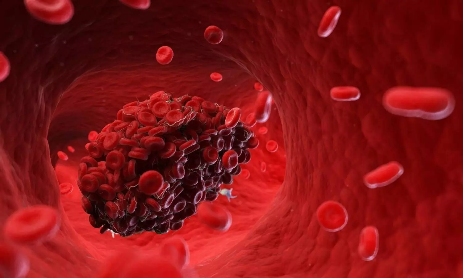 Image representing blood clots