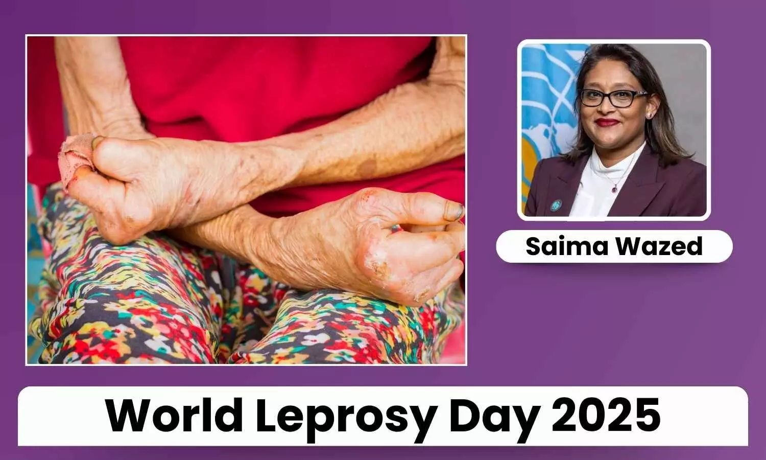 World Leprosy Day 2025: Unite, Act, and Eliminate Leprosy for Stigma Free Future - Saima Wazed