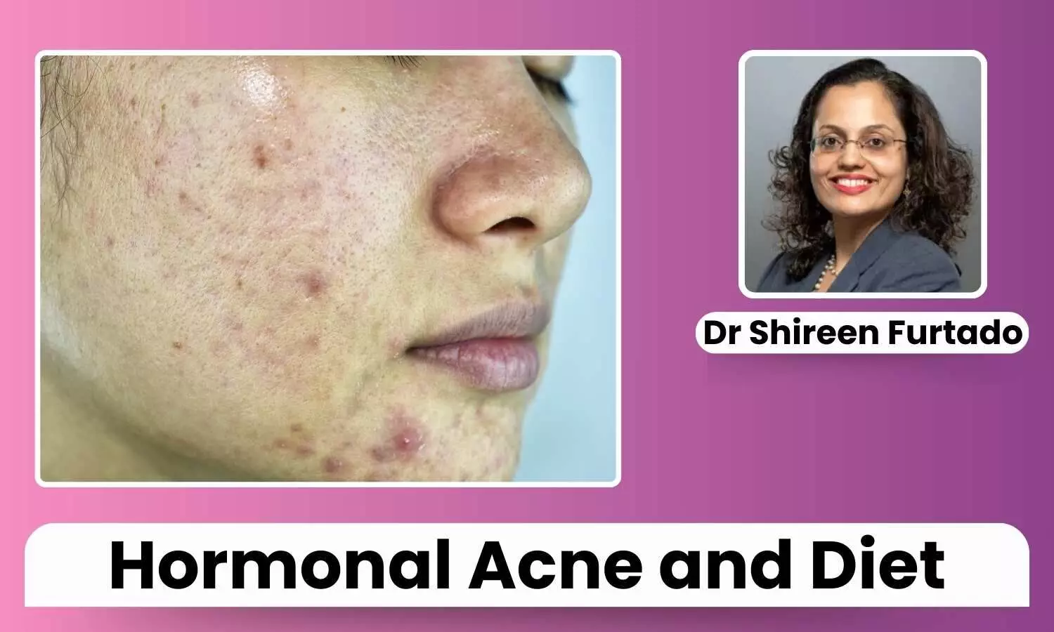 Featured image representing Acne