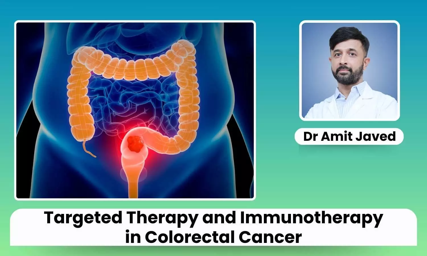 Featured image representing Colorectal cancer