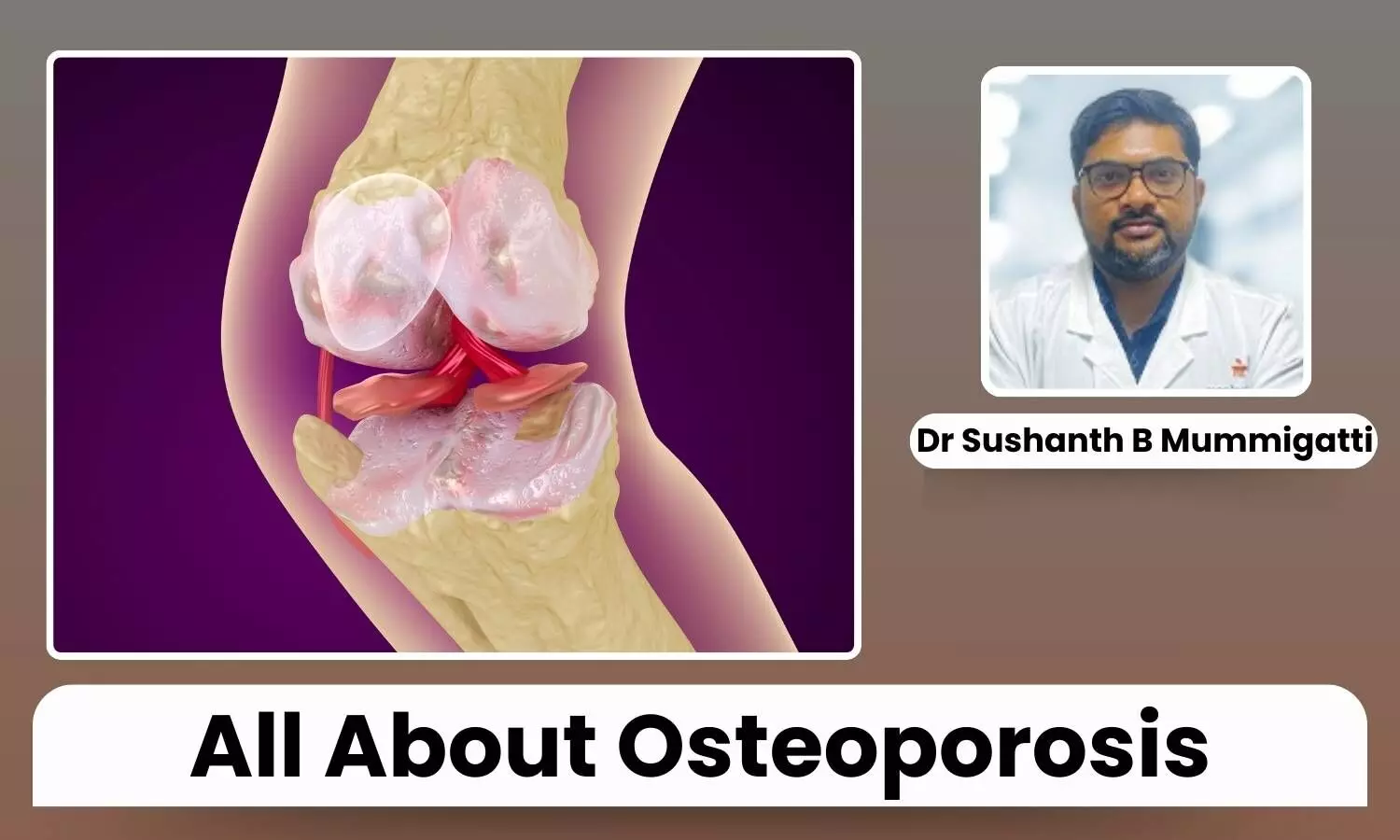 Featured image representing Osteoporosis in knee joint