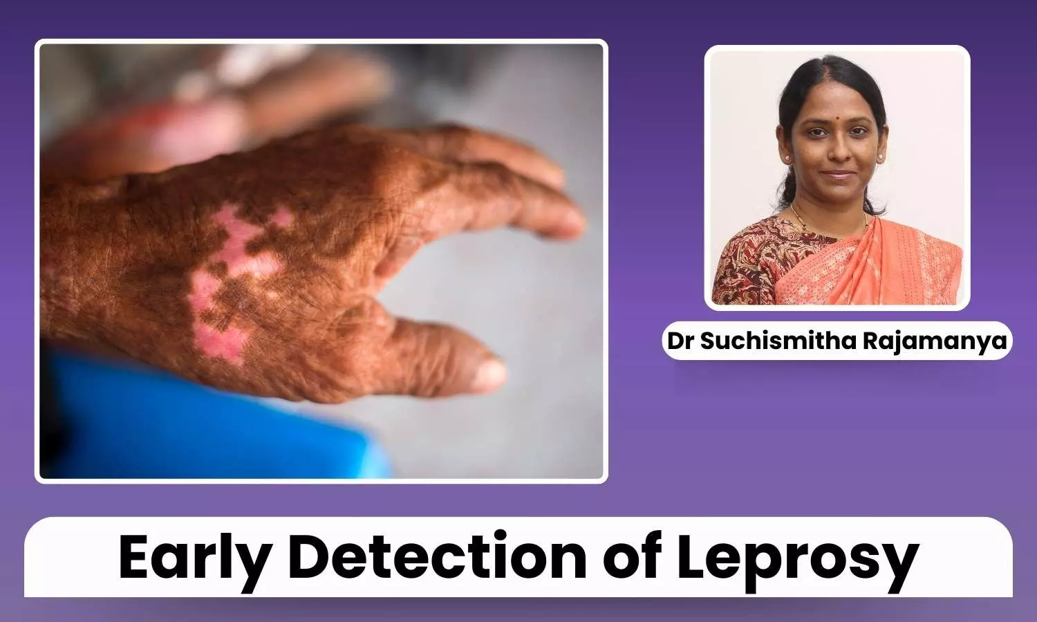 Featured image representing leprosy