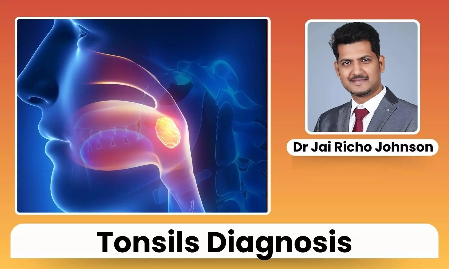 Featured image representing Tonsils