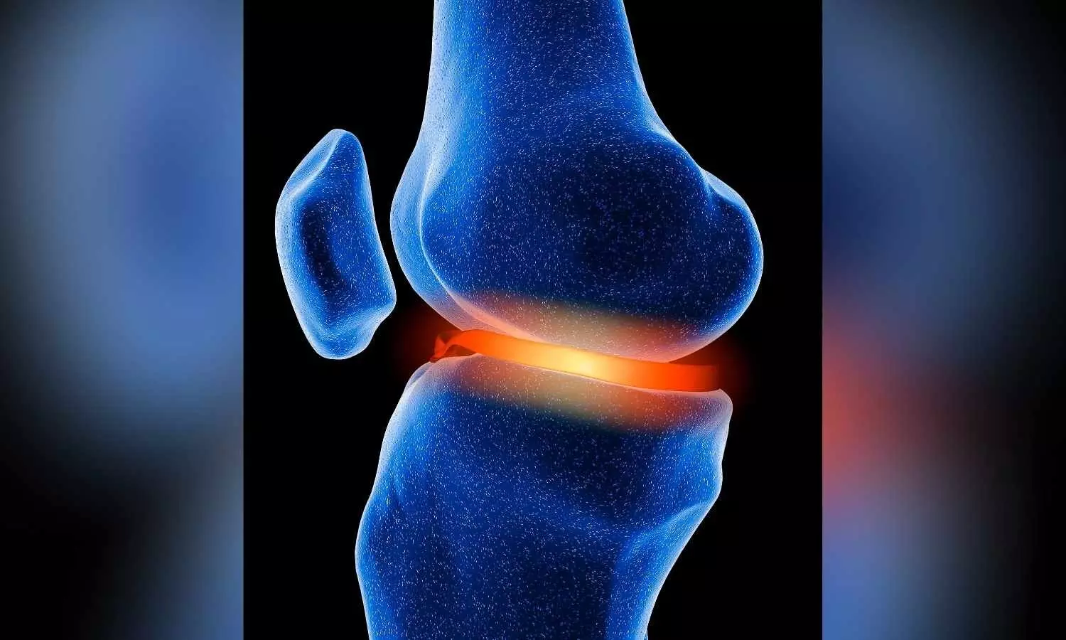 Image representing Knee Cartilage