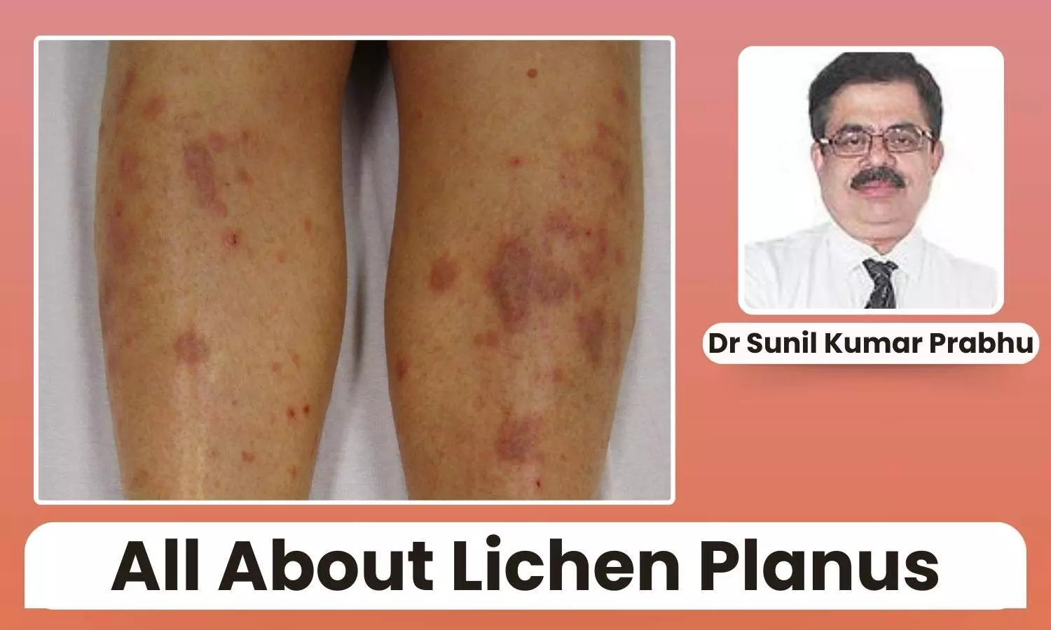 Featured image representing Lichen Planus