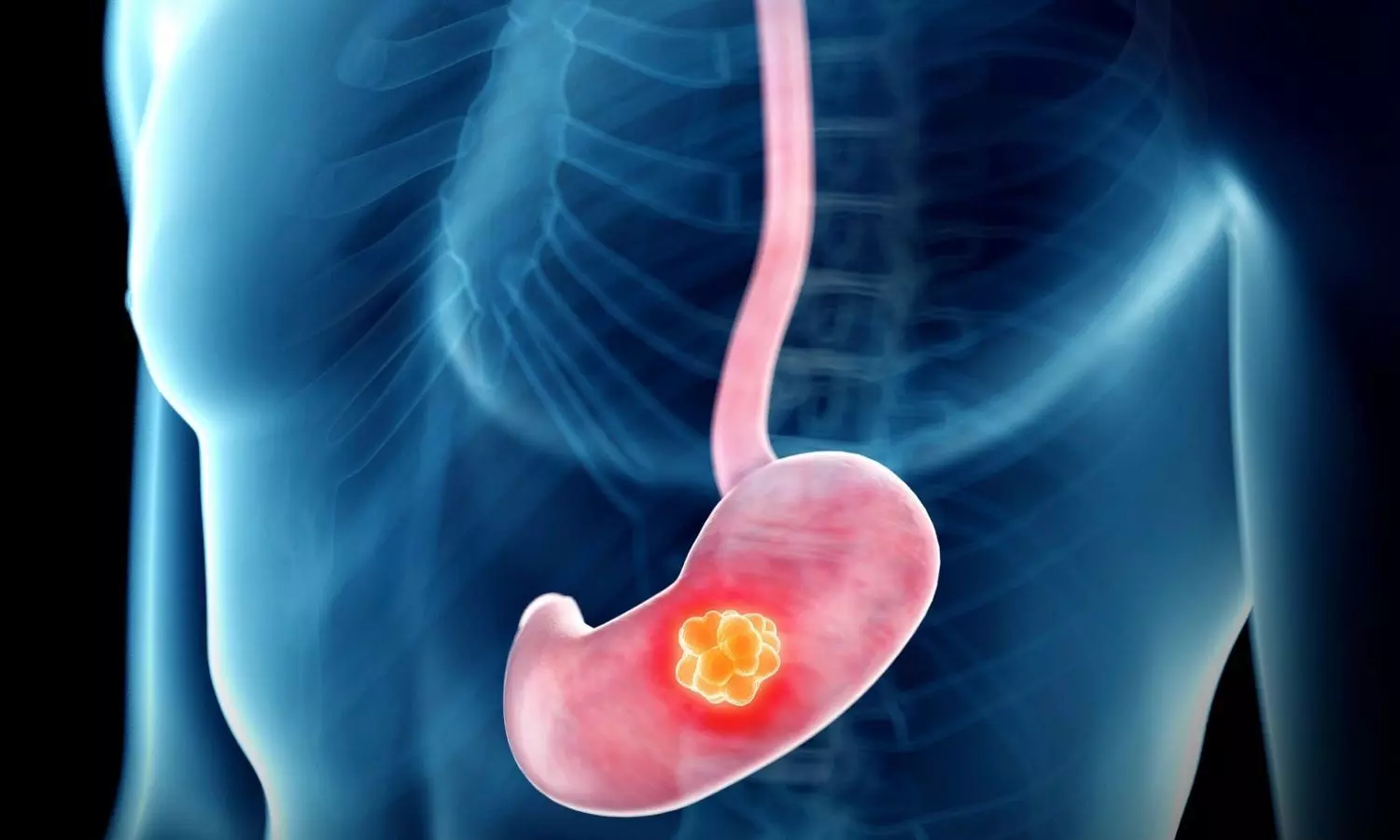 Image representing stomach cancer