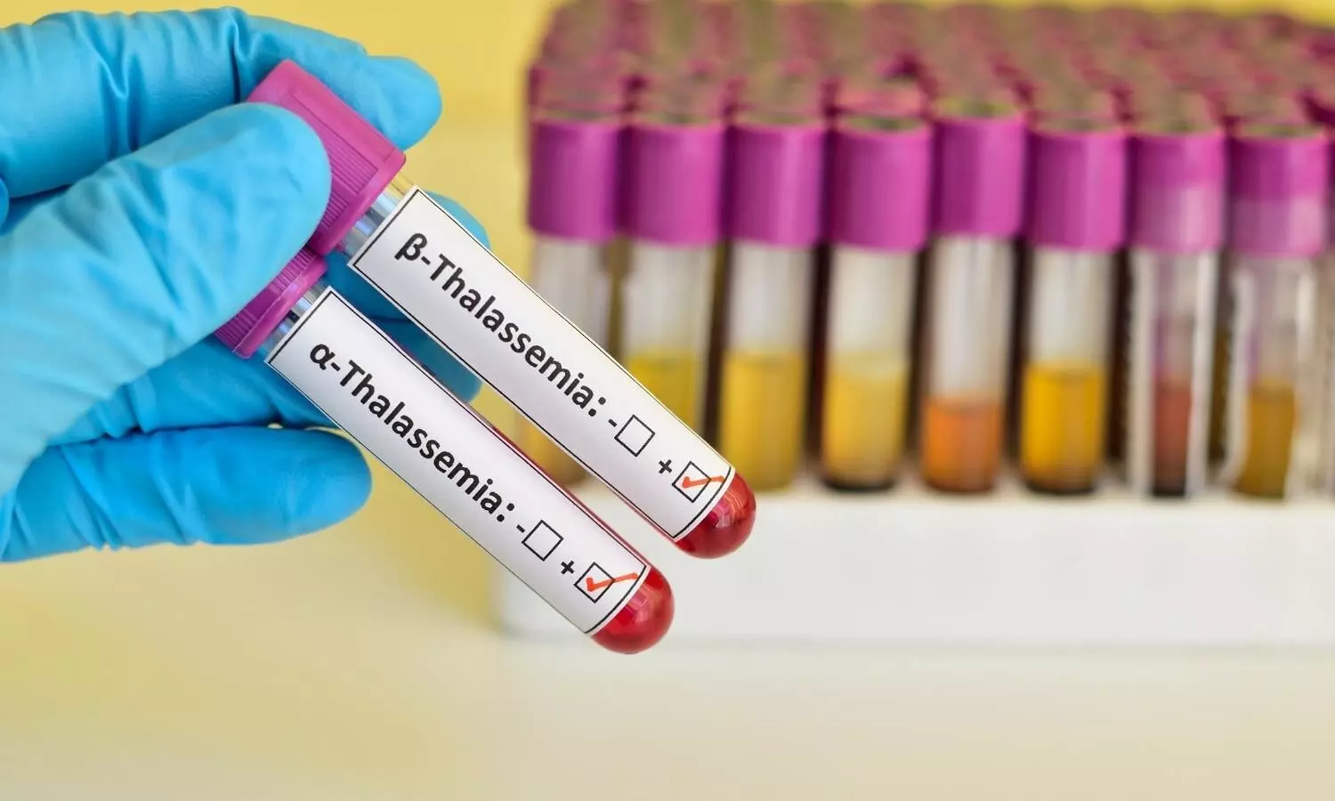 Image representing Thalassemia test