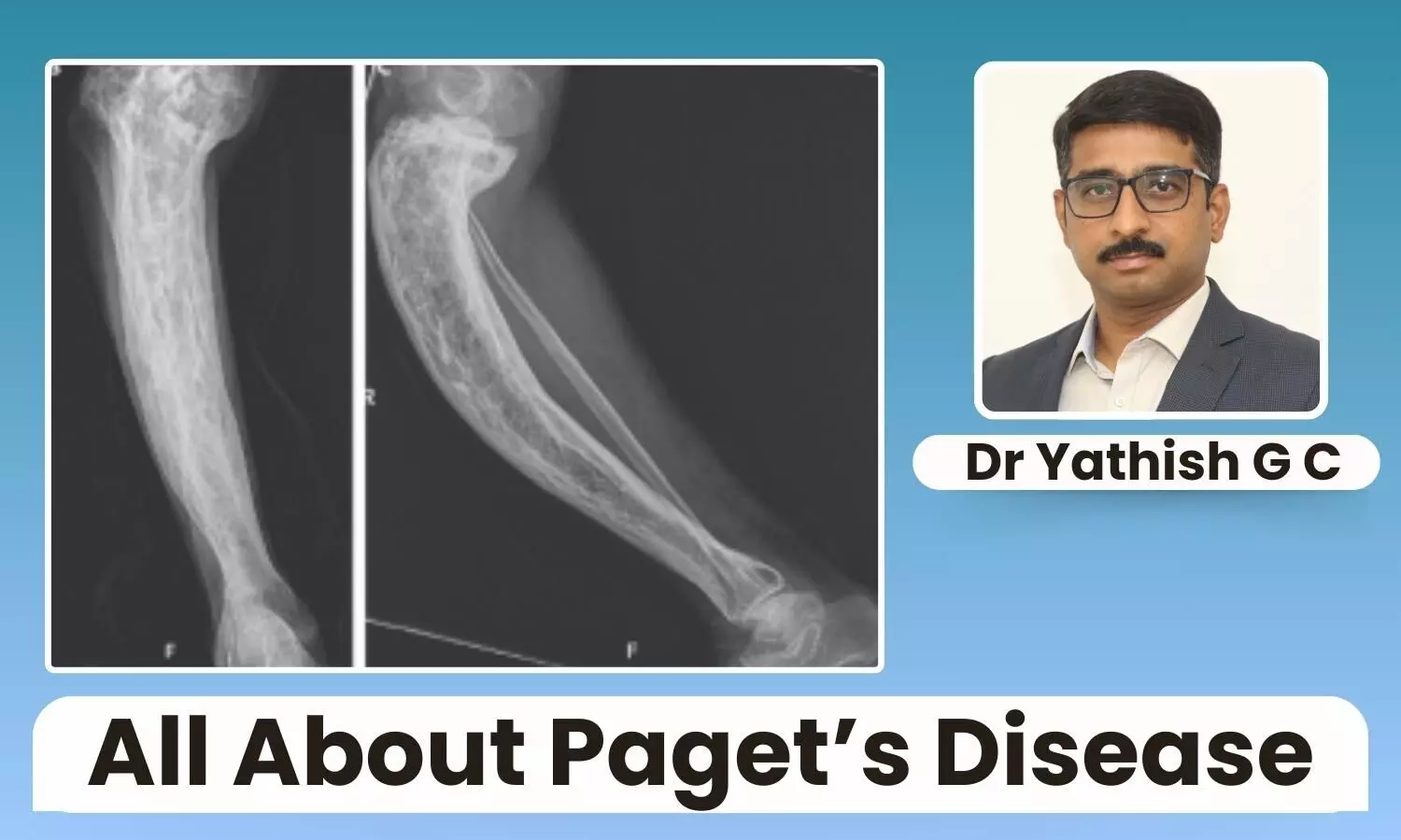 Featured image on Pagets Disease