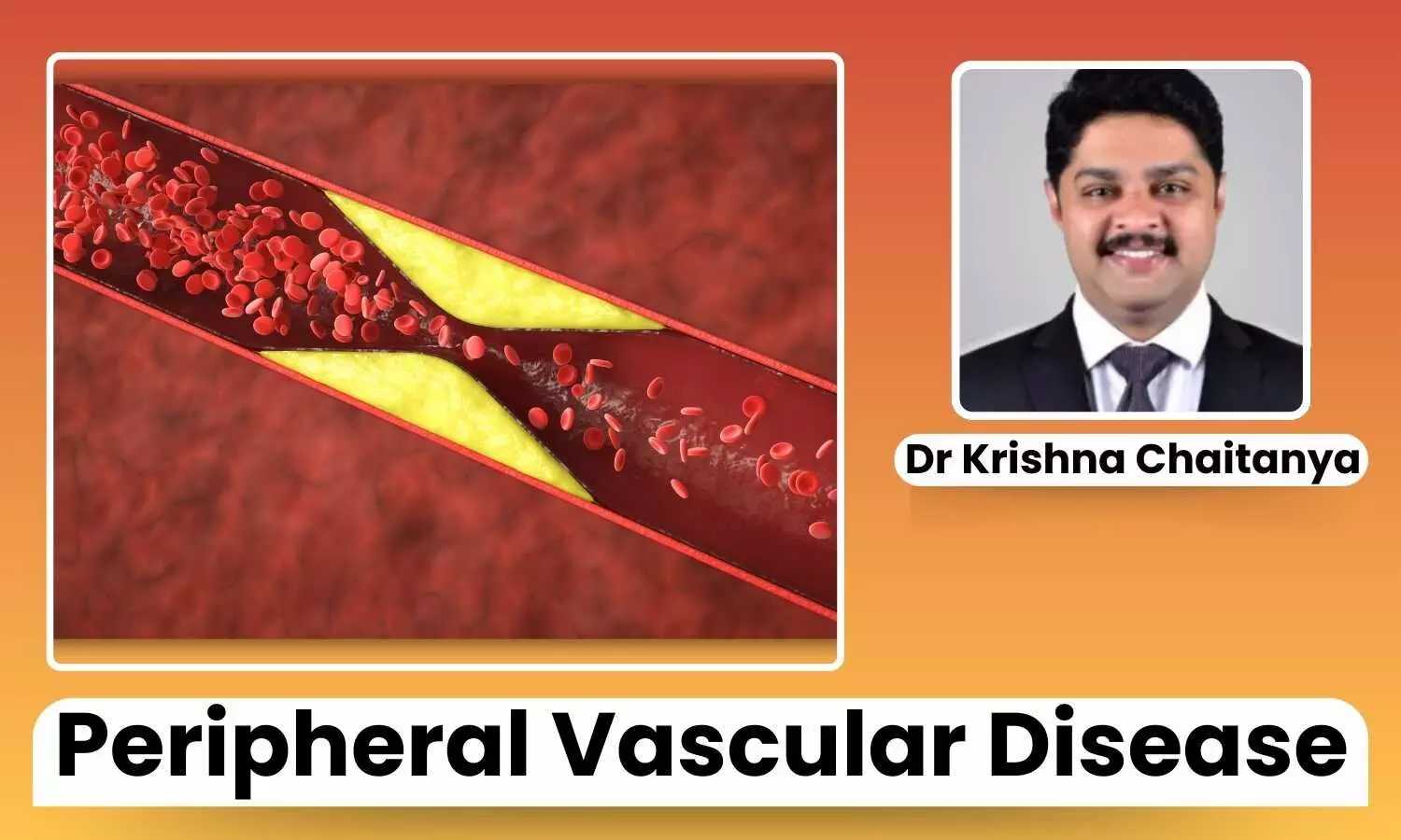 Why are Diabetics Prone to Peripheral Vascular Disease? - Dr Krishna Chaitanya