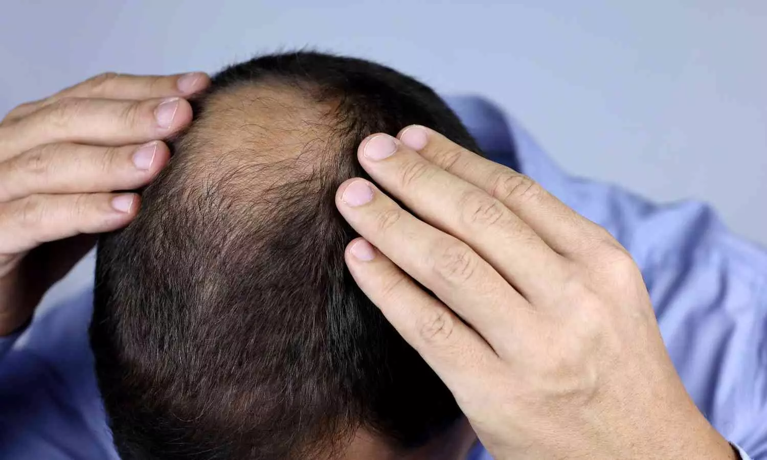 Image representing person with hair loss