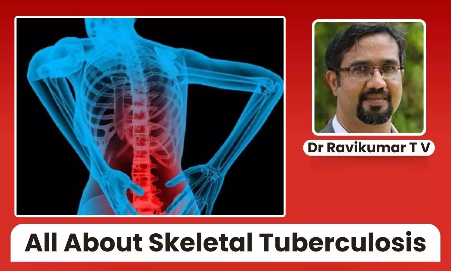 Skeletal Tuberculosis: Understanding Its Impact on Bones and Joints - Dr Ravikumar T V