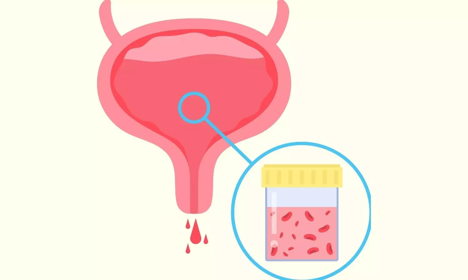 Graphic image representing blood in urine Graphic image representing blood in urine
