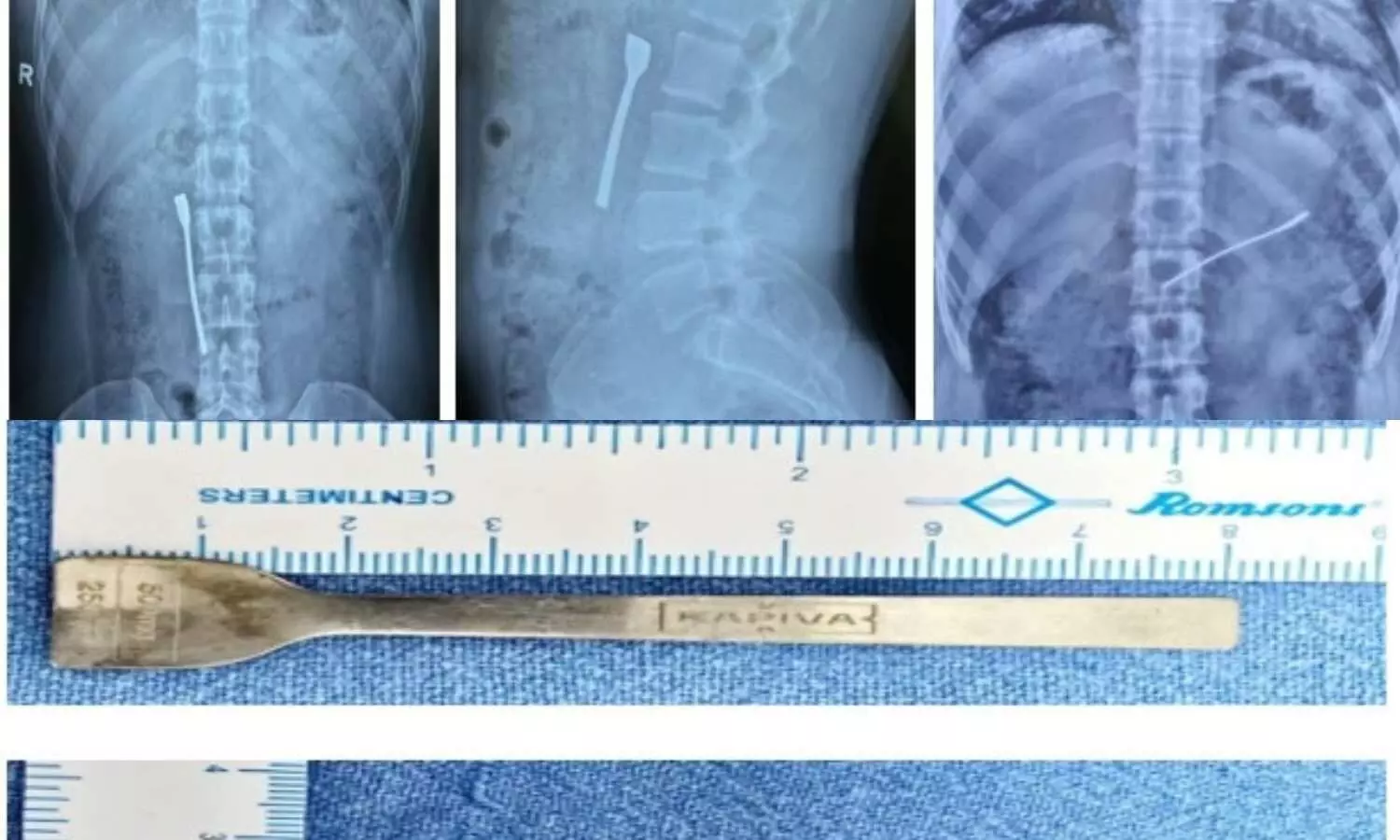 Xray image of the spoon stuck in intestine and the spoon Xray image of the spoon stuck in intestine and the spoon