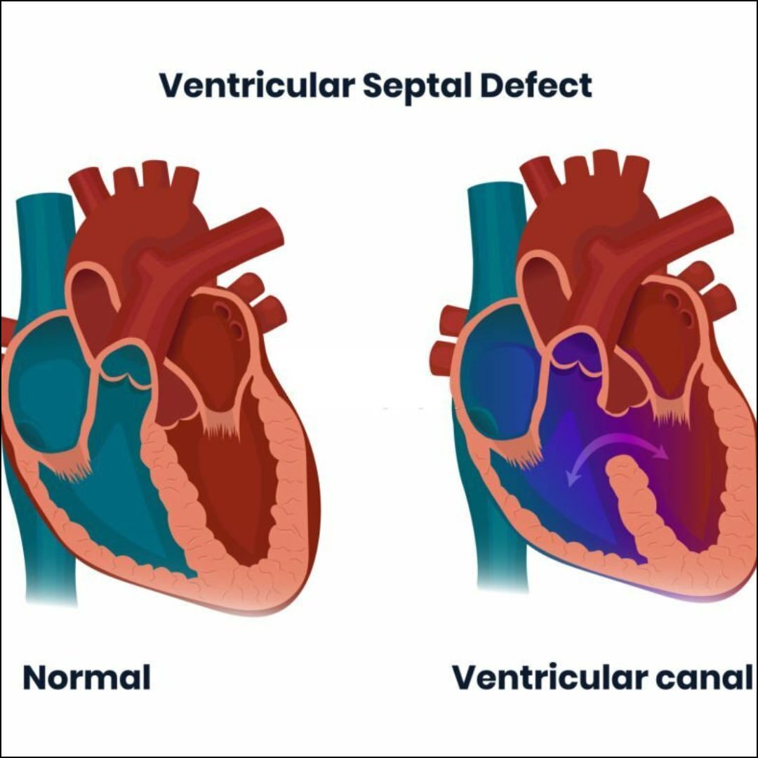 “Ventricular Septal Defect – Know Everything!”
