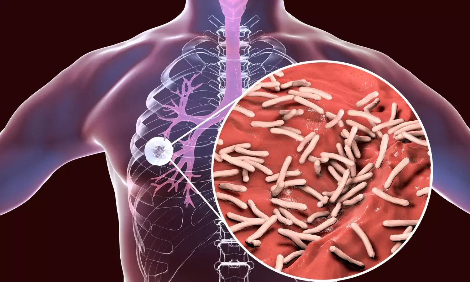 Metropolis Healthcare Secures Patent for Advanced TB Monitoring and Management System Metropolis Healthcare Secures Patent for Advanced TB Monitoring and Management System
