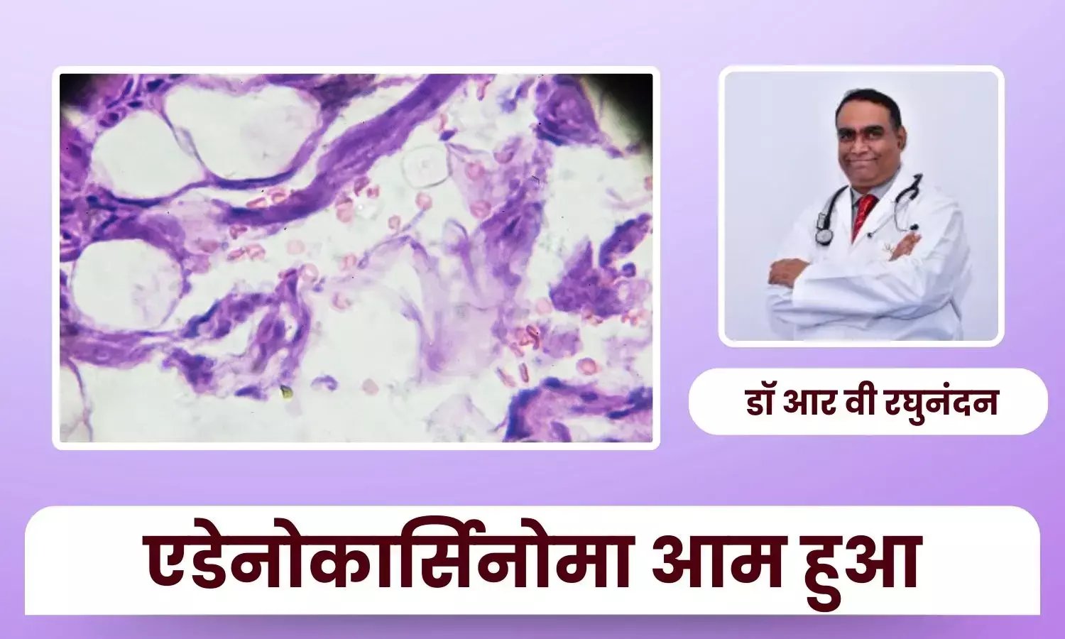 एडेनोकार्सिनोमा कैसे बन गया भारत में सबसे आम फेफड़े का कैंसर - डॉ आर वी रघुनंदन एडेनोकार्सिनोमा कैसे बन गया भारत में सबसे आम फेफड़े का कैंसर - डॉ आर वी रघुनंदन