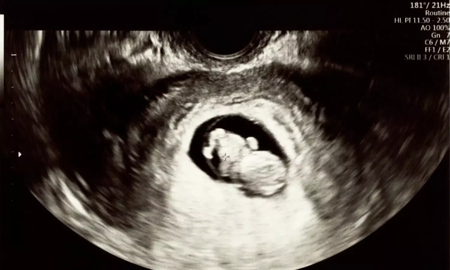 Study Links Pregnancy Antibiotics to Higher Bacterial Disease Risk in Infants