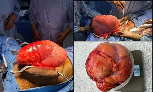 10.4 kgs Abdominal Tumour measuring 50 cms Successfully Removed from 80-year-old Woman at Fortis Escorts Okhla
