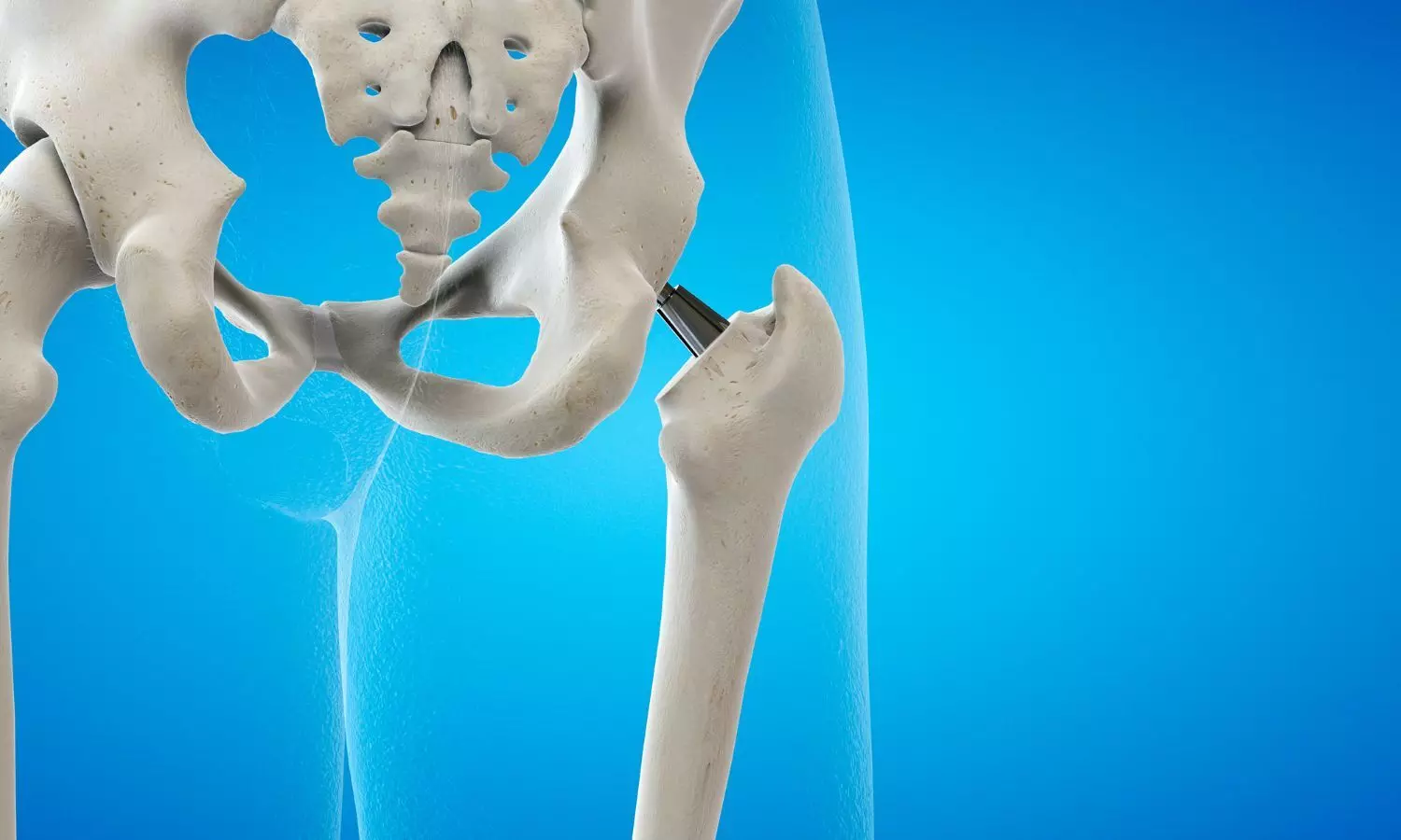 3D Navigation Transforms Hip Replacement: Patient Walks Freely After IntelliJoint Surgery 3D Navigation Transforms Hip Replacement: Patient Walks Freely After IntelliJoint Surgery