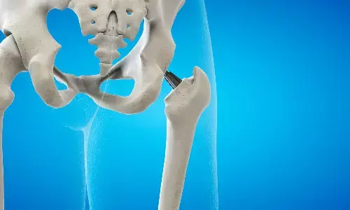 3D Navigation Transforms Hip Replacement: Patient Walks Freely After IntelliJoint Surgery