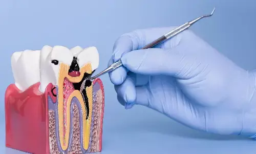 दांतों के लिए साइलेंट किलर है सड़न, जानें कब बढ़ सकती है दांतों से जुड़ी समस्याएं