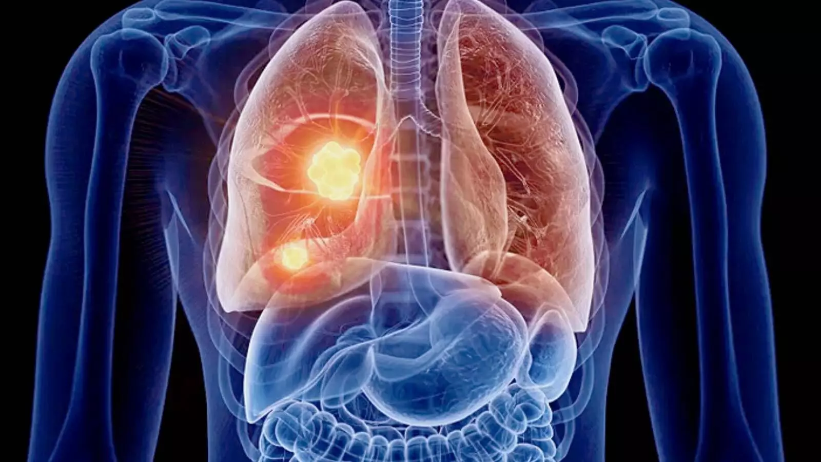 Lung Cancer Symptoms: फेफड़ों का कैंसर, लक्षण, कारण और बचाव के आधुनिक उपाय
