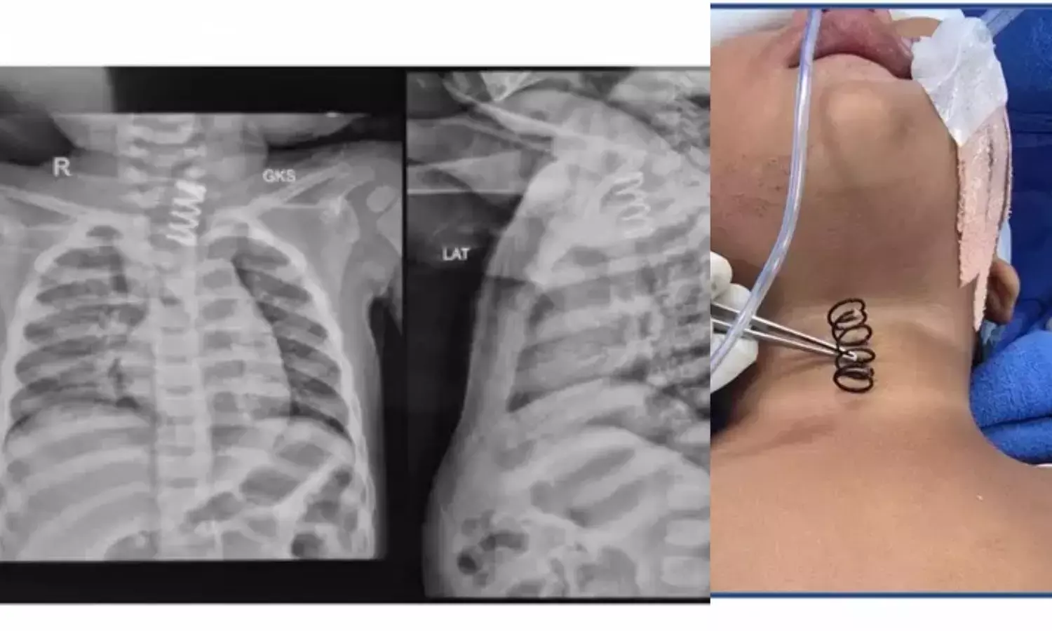 14 महीने के बच्चे ने निगला मेटल स्प्रिंग, एम्स डॉक्टरों ने सुरक्षित निकाला