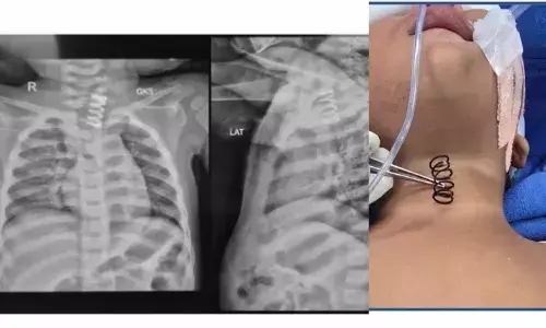 14-Month-Old Swallows Metal Spring, AIIMS Doctors Perform Life-Saving Procedure 14-Month-Old Swallows Metal Spring, AIIMS Doctors Perform Life-Saving Procedure