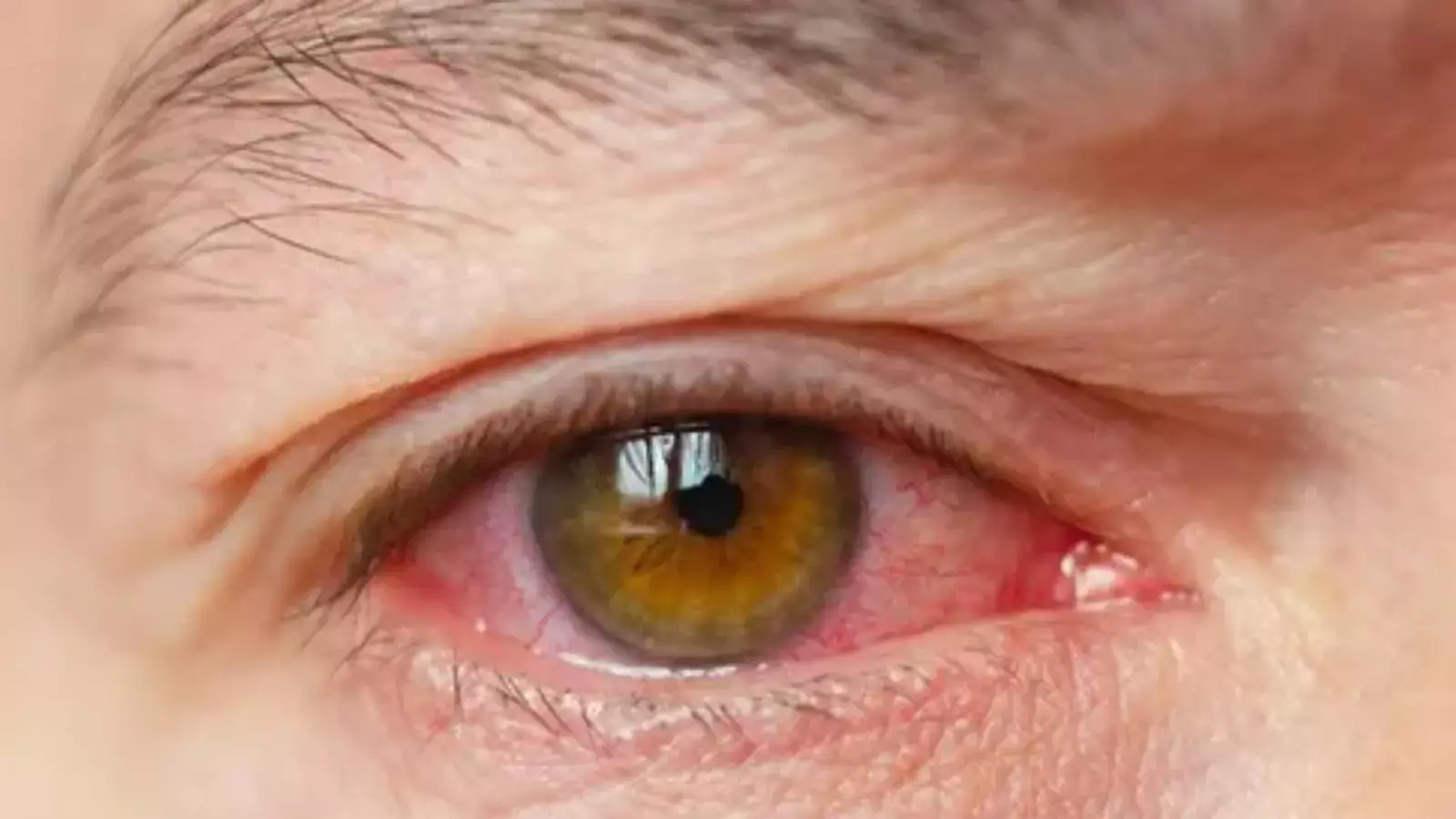 आंखों में जलन और सूखापन? राहत पाने के लिए अपनाएं ये आसान घरेलू उपाय