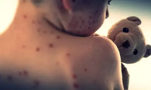 मंगोलिया में खसरे का प्रकोप बढ़ा, संक्रमितों की संख्या 14,000 के पार