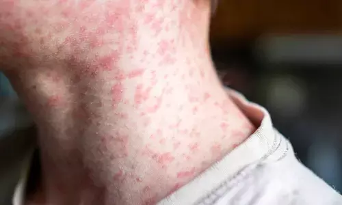लंदन के स्कूलों में खसरे (Measles) का तांडव, तेजी से फैल रहा है संक्रमण, कई बच्चे अस्पताल में भर्ती