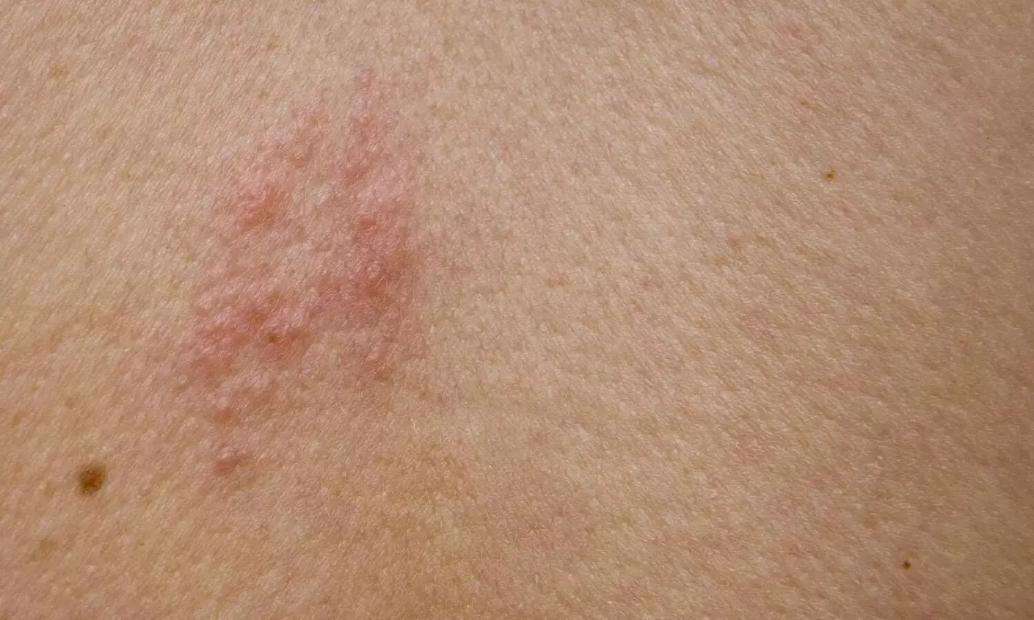 क्या आपको भी होता है शरीर के एक हिस्से में दर्द या झुनझुनी? नजरअंदाज न करें, यह Shingles हो सकता है क्या आपको भी होता है शरीर के एक हिस्से में दर्द या झुनझुनी? नजरअंदाज न करें, यह Shingles हो सकता है