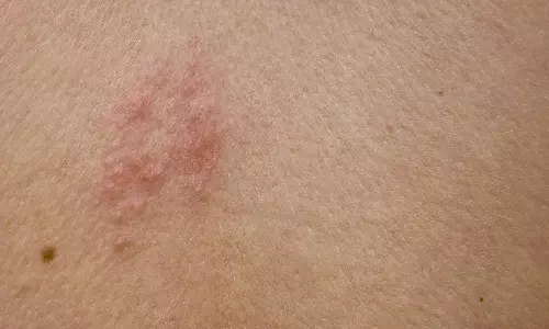 क्या आपको भी होता है शरीर के एक हिस्से में दर्द या झुनझुनी? नजरअंदाज न करें, यह Shingles हो सकता है