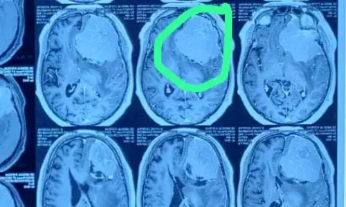 64-Year-Old Man Gets New Life After Doctors Remove Massive 700g Brain Tumor
