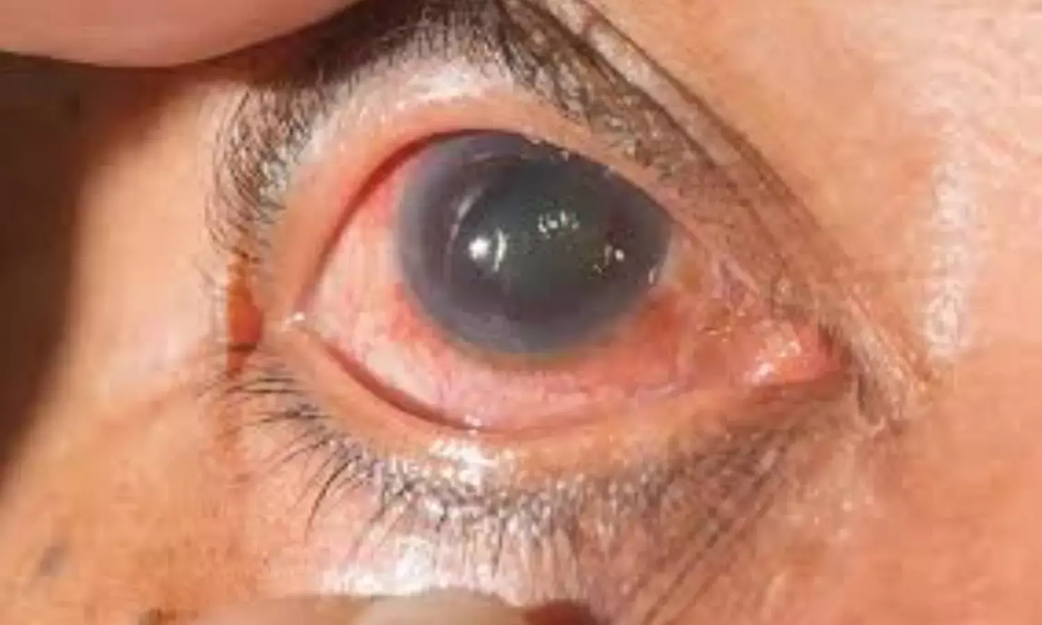 ग्लूकोमा, आंखों की रोशनी चुराने वाला साइलेंट किलर, भारत में 1.2 करोड़ लोग प्रभावित, जानें बचाव के तरीके