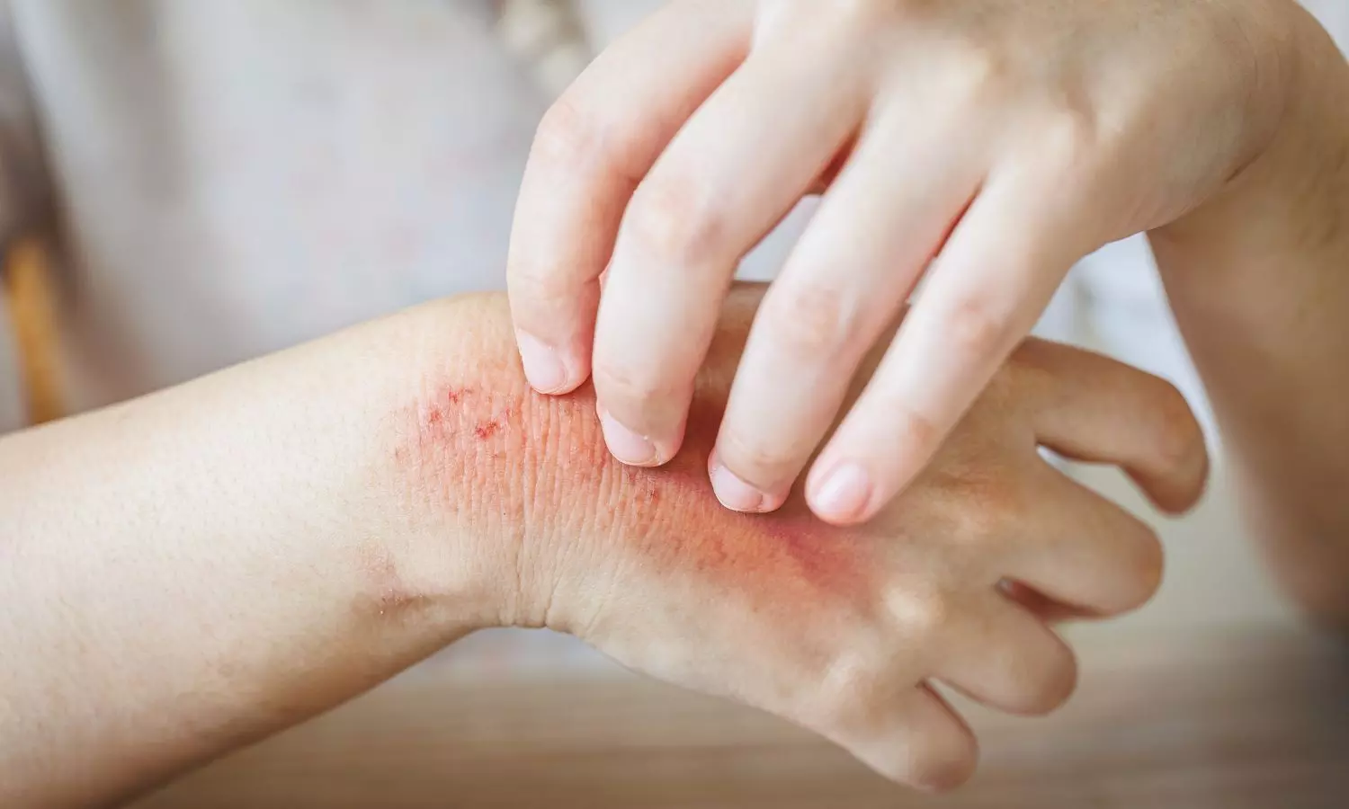 Digvijaya Singh Raises Alarm Over Skin Disease Outbreak in Betul, Seeks Action Digvijaya Singh Raises Alarm Over Skin Disease Outbreak in Betul, Seeks Action