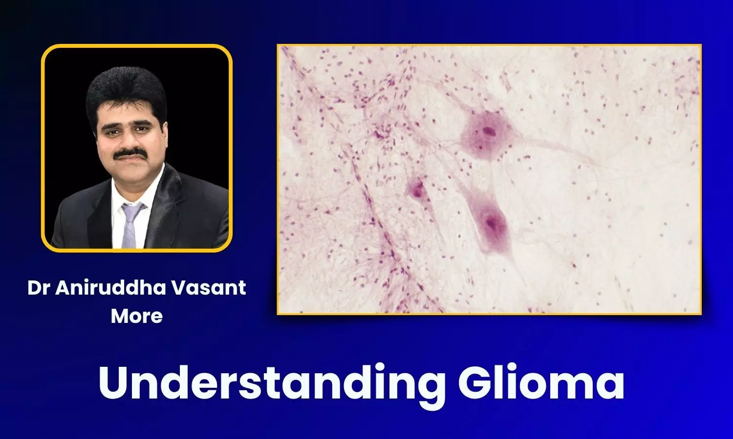 Glioma Explained: Causes, Symptoms & Treatment Options - Dr Aniruddha Vasant More Glioma Explained: Causes, Symptoms & Treatment Options - Dr Aniruddha Vasant More