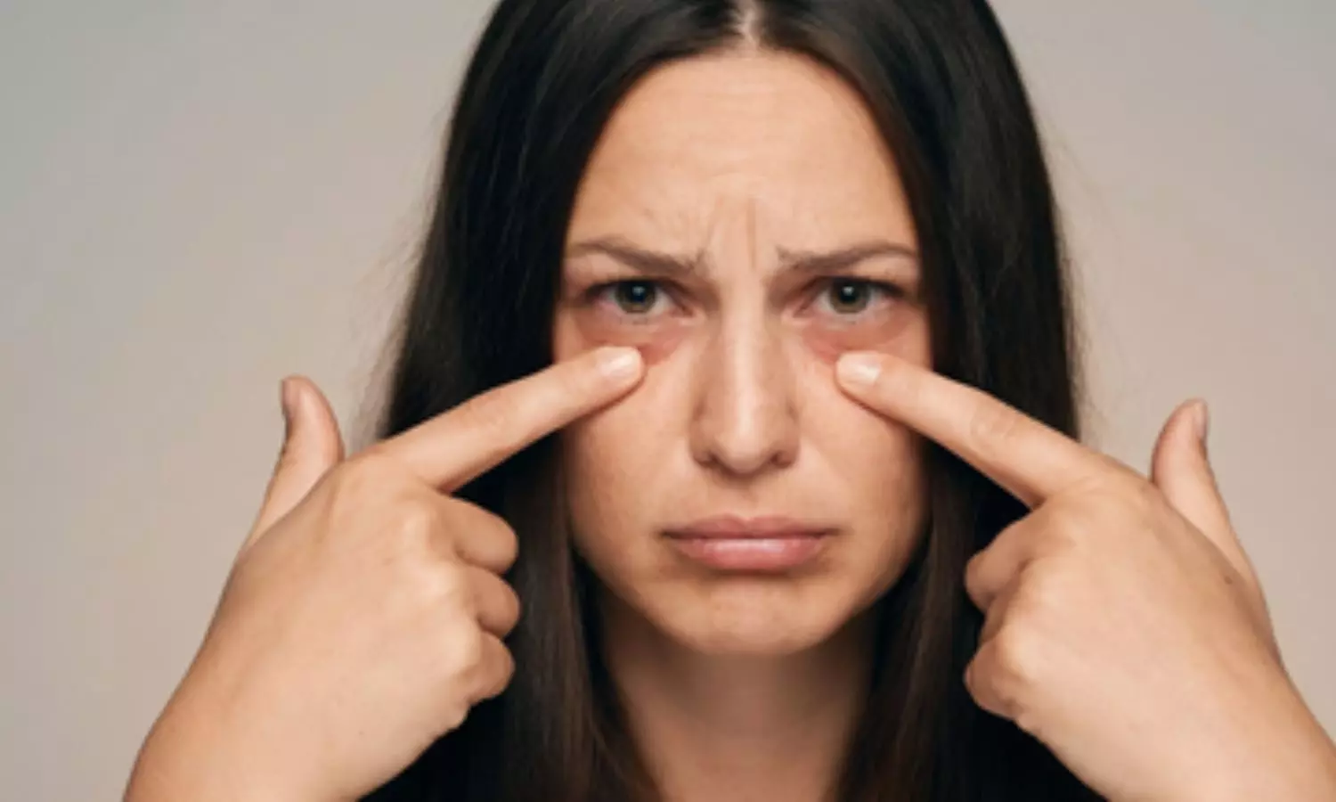 लगातार आंखों की सूजन को नजरअंदाज करना जोखिम भरा, हो सकता है किडनी से जुड़ी बीमारी का शुरुआती संकेत लगातार आंखों की सूजन को नजरअंदाज करना जोखिम भरा, हो सकता है किडनी से जुड़ी बीमारी का शुरुआती संकेत