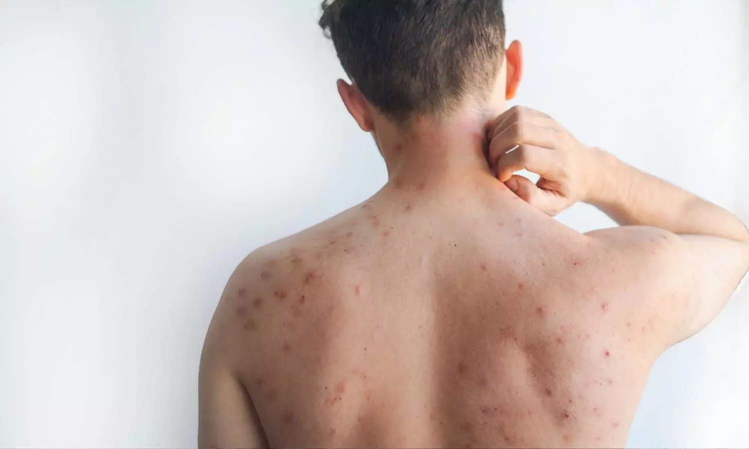 Bangladesh Measles Outbreak Worsens as Cases Surge Bangladesh Measles Outbreak Worsens as Cases Surge