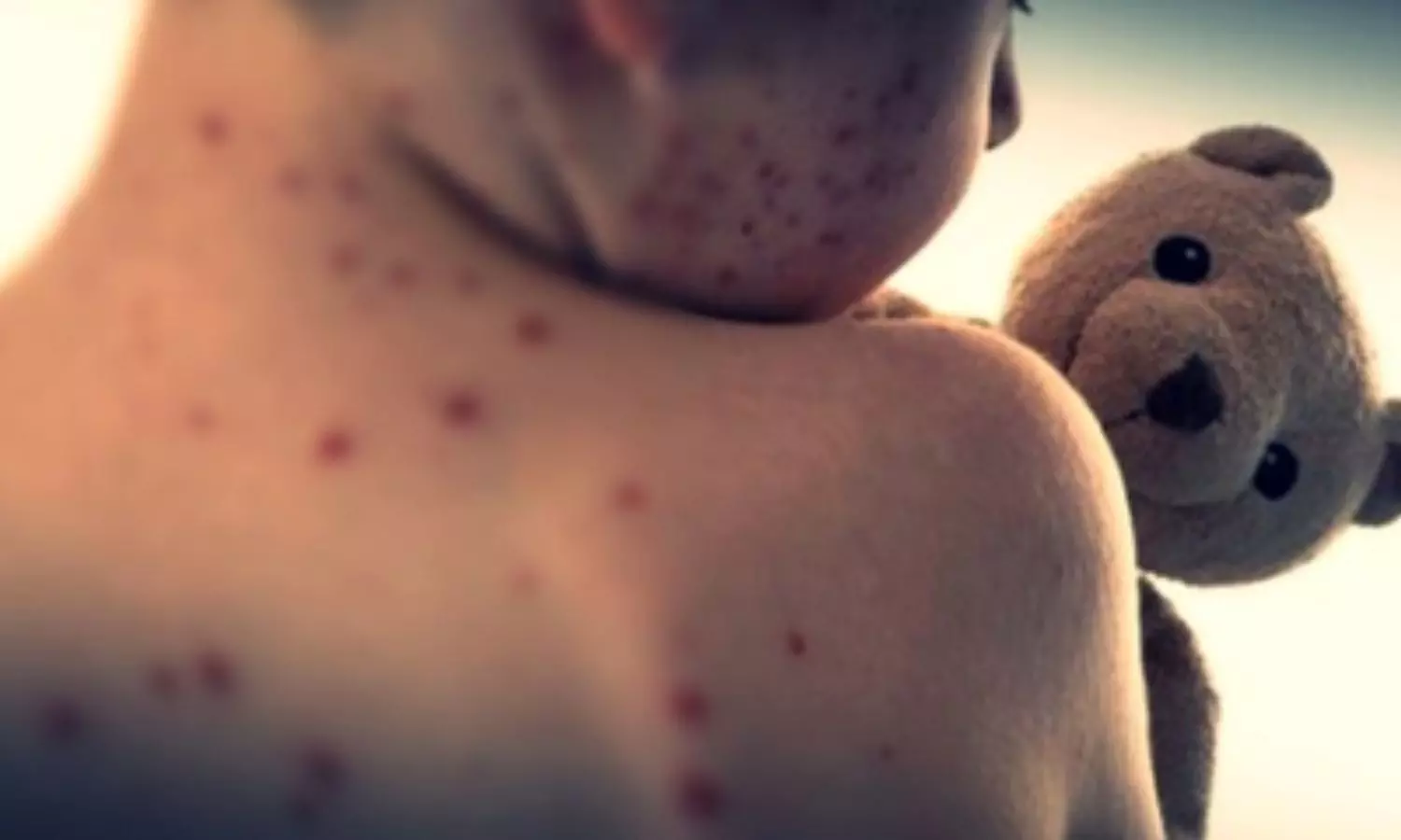 बांग्लादेश में तेजी से फैल रहा खसरा, 38 बच्चों की मृत्यु बांग्लादेश में तेजी से फैल रहा खसरा, 38 बच्चों की मृत्यु