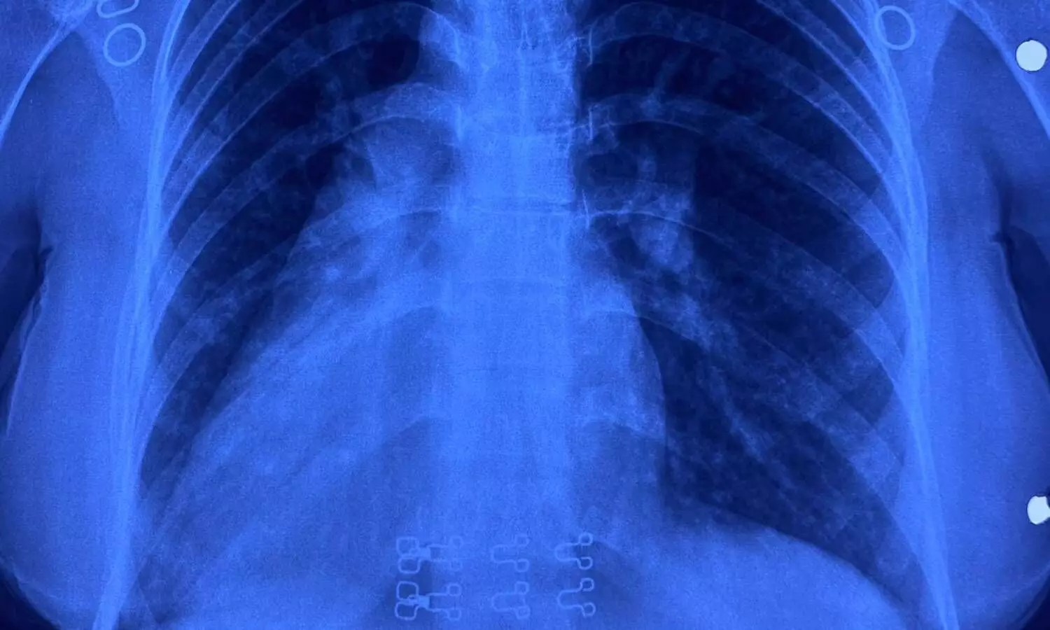 दिल्ली के RML अस्पताल में ग्लोबल फर्स्ट हार्ट सर्जरी, सीना चीरे बिना ठीक किया उल्टा दिल, जानें क्या है साइटस इन्वर्सस दिल्ली के RML अस्पताल में ग्लोबल फर्स्ट हार्ट सर्जरी, सीना चीरे बिना ठीक किया उल्टा दिल, जानें क्या है साइटस इन्वर्सस